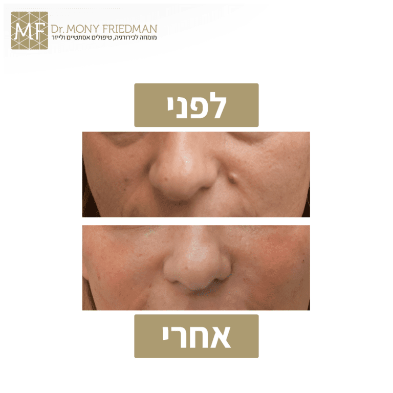 הזרת נגע 4