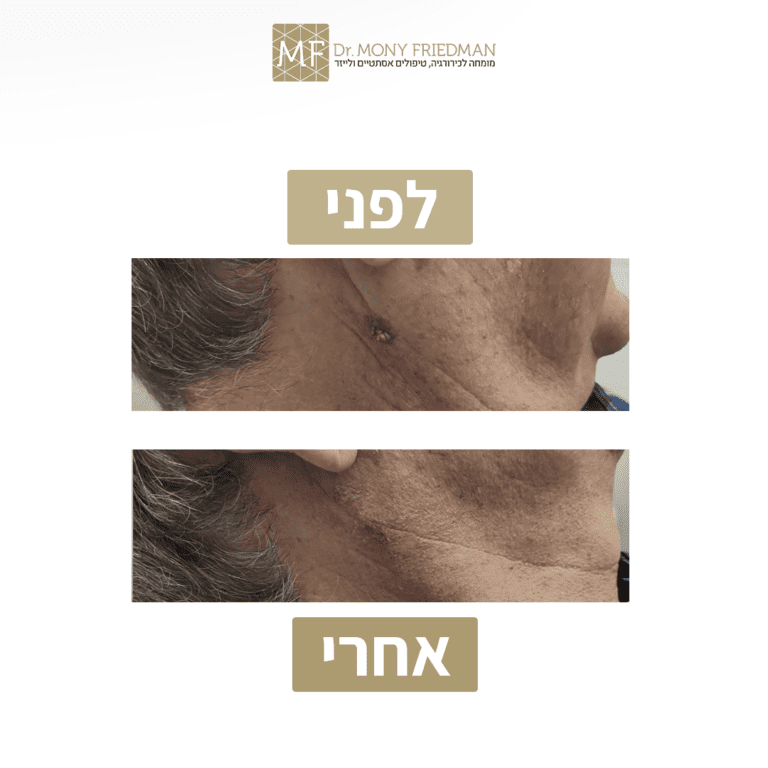 הסרת נגע 2