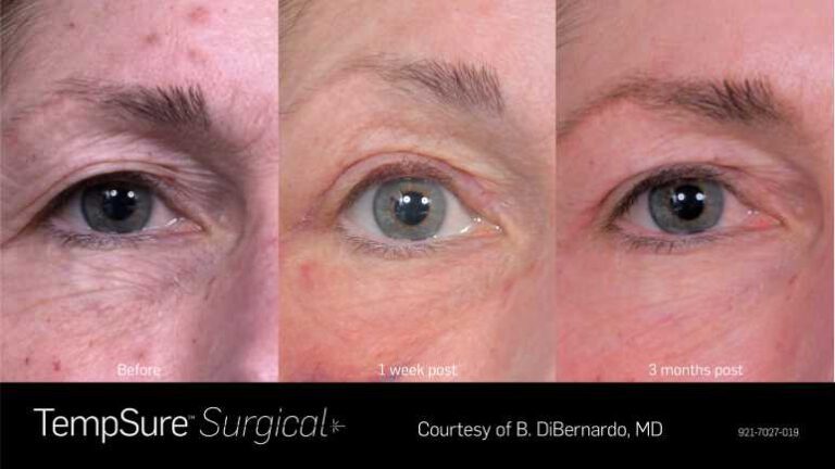 921-7027-019_PRD-1945_TempSure_surgical_BAs_Before_1_week_post_3_months_post