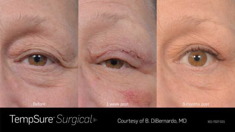921-7027-021_PRD-1945_TempSure_surgical_BAs_Before_1_week_post_3_months_post