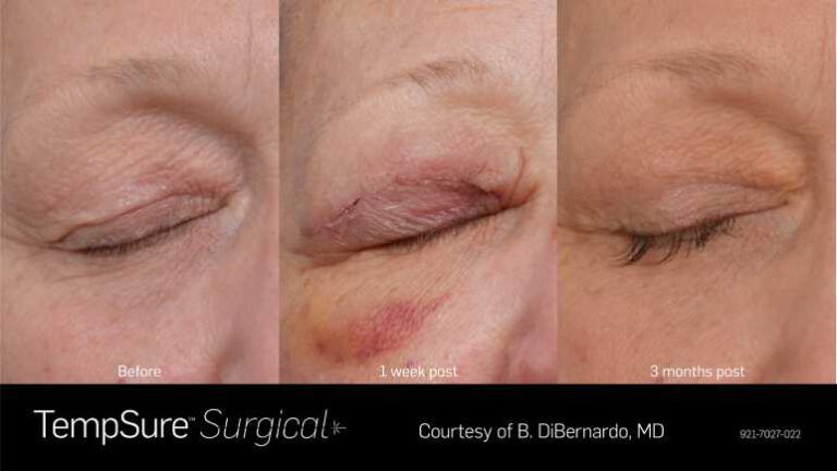 921-7027-022_PRD-1945_TempSure_surgical_BAs_Before_1_week_post_3_months_post
