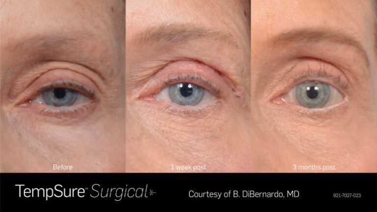 921-7027-023_PRD-1945_TempSure_surgical_BAs_Before_1_week_post_3_months_post