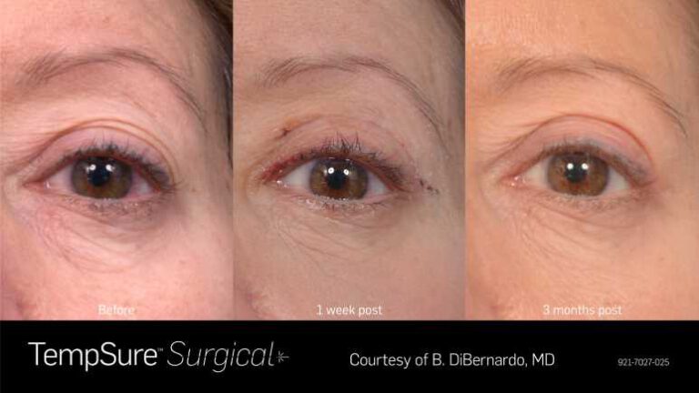 921-7027-025_PRD-1945_TempSure_surgical_BAs_Before_1_week_post_3_months_post