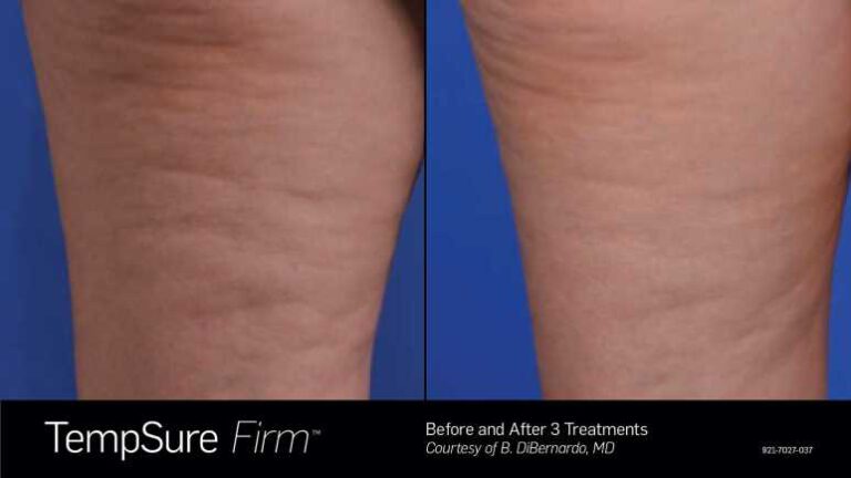 921-7027-037_TempSure_Firm_B&A_-_Dr._DiBernardo