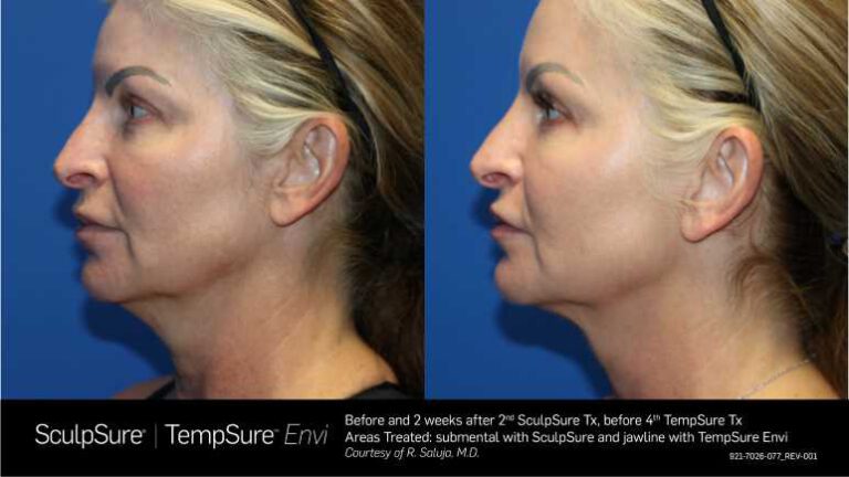ProfileEnvi_TempSure_SculpSure_BA_1