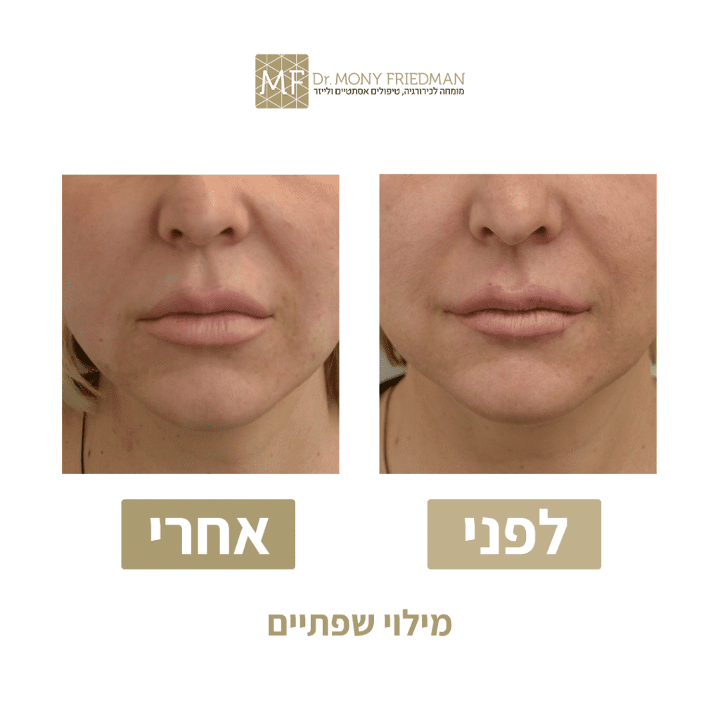 מילוי שפתיים לפני ואחרי