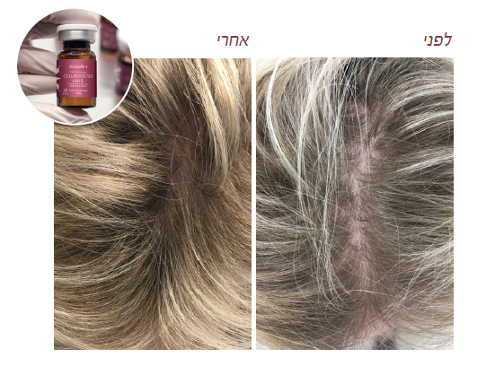 טיפול CELLBOOSTER HAIR - לפני ואחרי
