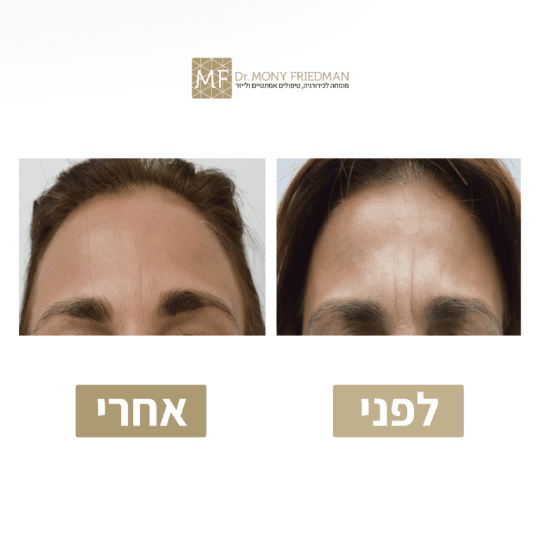 קמט זעף
