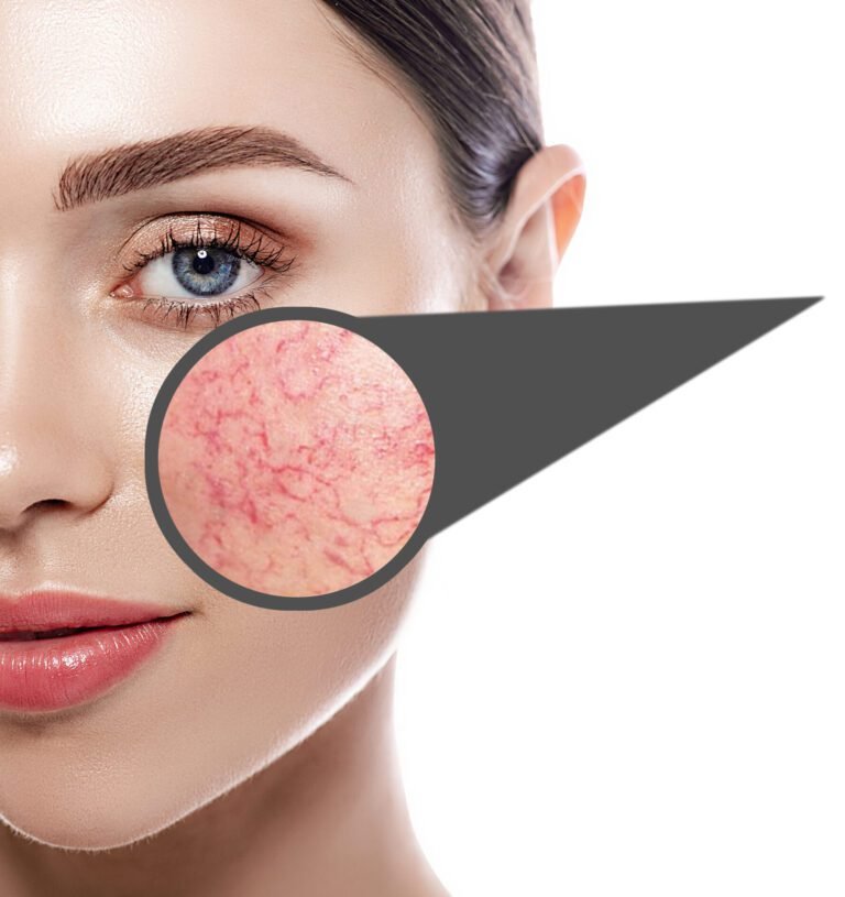 Magnifying glass showing couperose on face skin