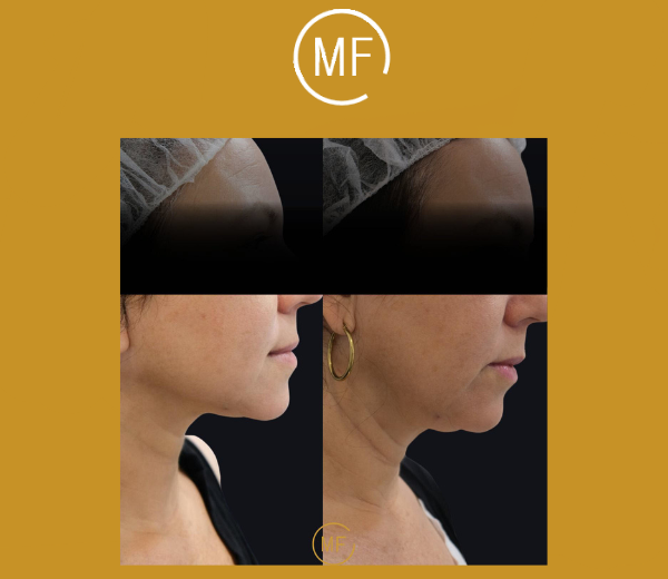 מתיחת פנים ללא ניתוח - תמונות לפני ואחרי