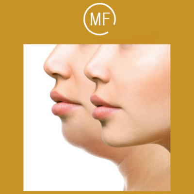 פייסטיט - facetite - מתיחת פנים ללא ניתוח