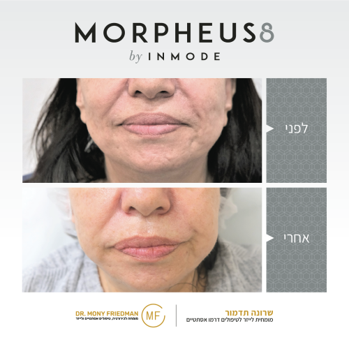 לפני ואחרי טיפול בלייזר לקמטים