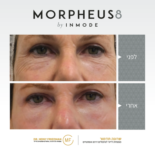 העלמת קמטים בלייזר