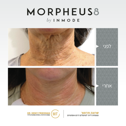 לפני ואחרי טיפול בלייזר נגד קמטים