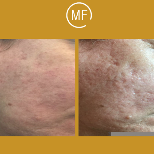 טיפול בצלקות ובסימני מתיחה לפני ואחרי