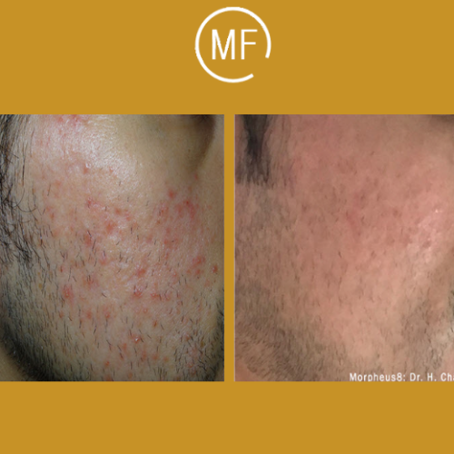 טיפול בצלקות ובסימני מתיחה לפני ואחרי