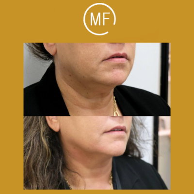 פייסטיט מתיחת פנים - לפני ואחרי