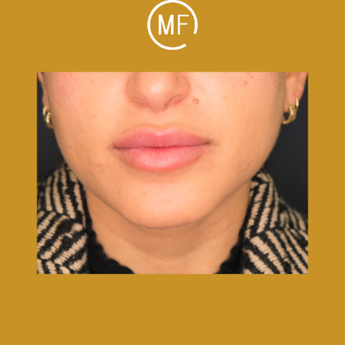 עיבוי שפתיים - לפני ואחרי