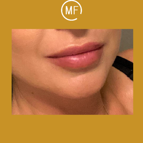 החיוך המושלם - אחרי