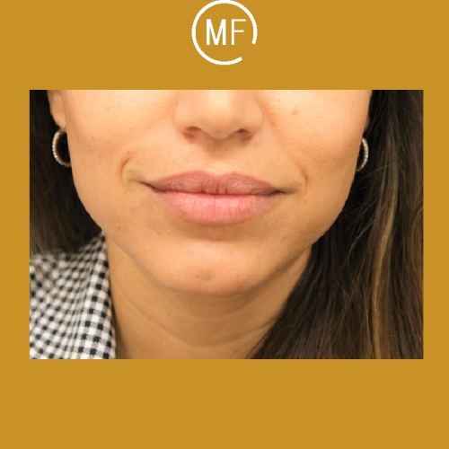 החיוך המושלם - עיצוב שפתיים