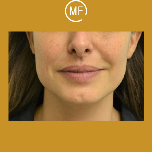 שפתיים לחיוך מושלם - אחרי הטיפול