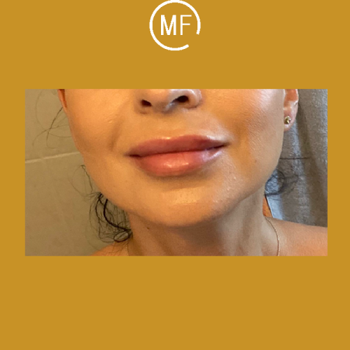 עיבוי שפתיים - תמונה אחרי