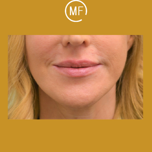 עיבוי שפתיים