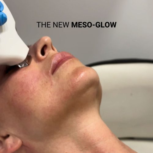 the new meso-glow (3)