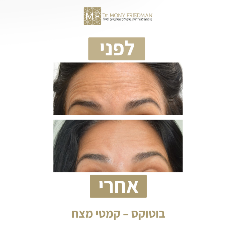 הזרקות בוטוקס 2
