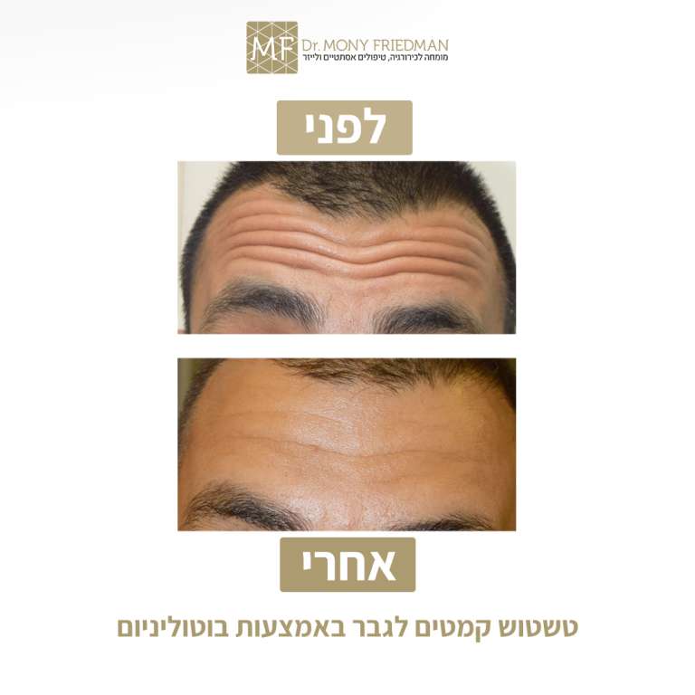 הזרקות בוטוקס