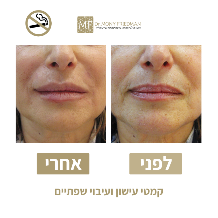 הזרקות ספתיים