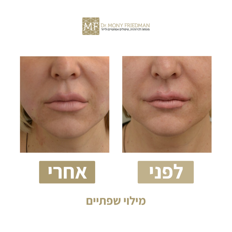 הזרקות שפתיים 1