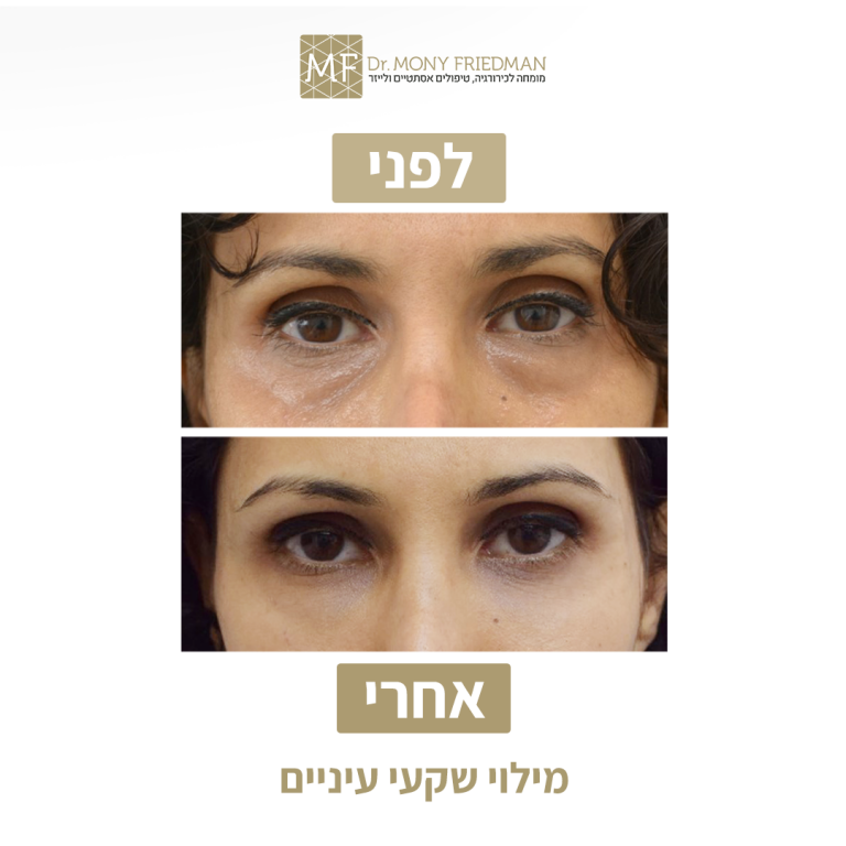 הזרקות שקעי עיניים