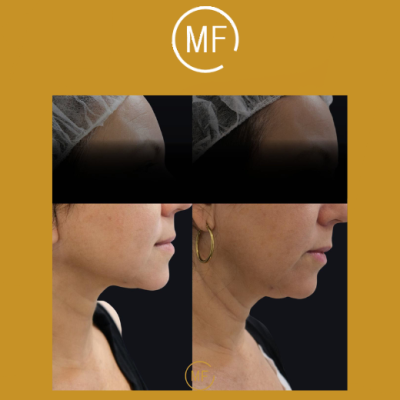 מתיחת פנים ללא ניתוח - תמונות לפני ואחרי