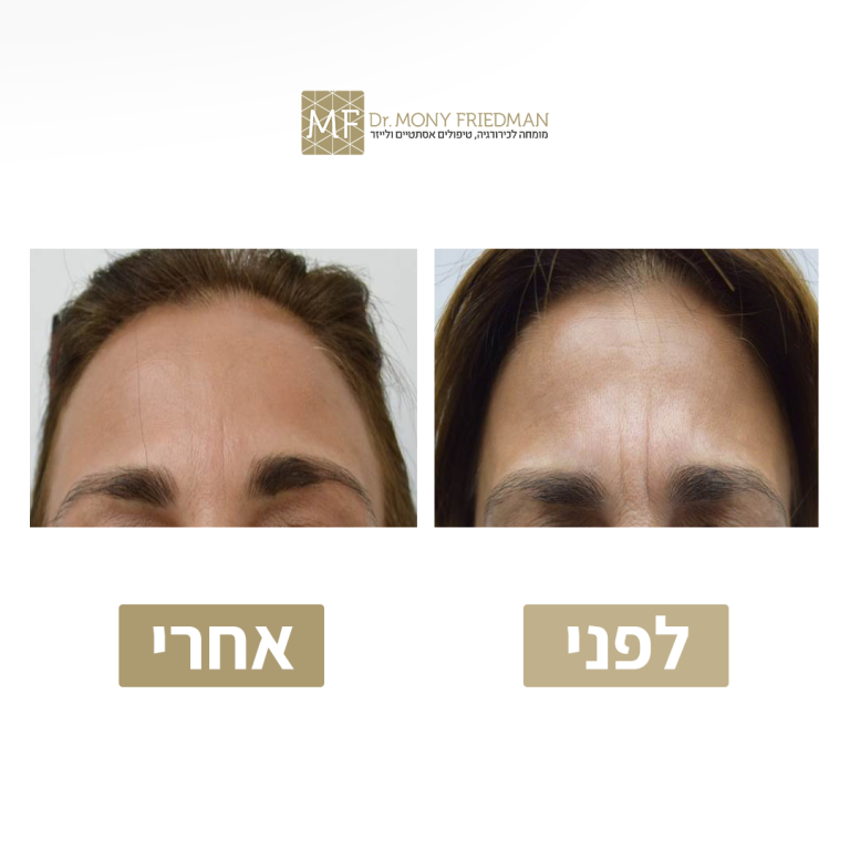 קמט זעף
